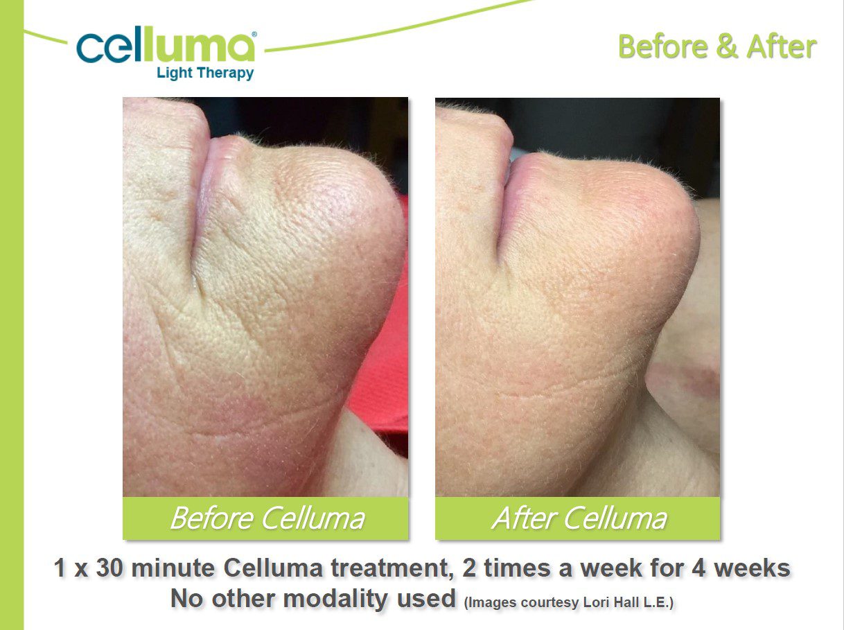 A before and after picture of the effects of celuma